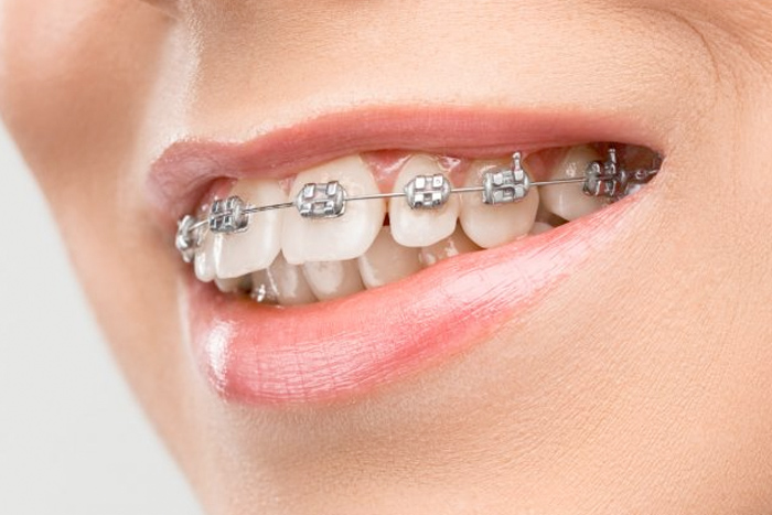 Ortodontie si aparate dentare la cabinet stomatologic Ovidiu