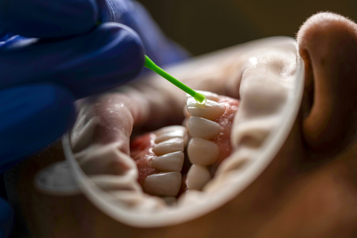 Profilaxie dentara si detartraj profesional la dentist Ovidiu Constanta